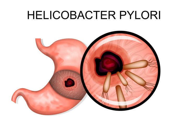 هلیکوباکتر پیلوری H. pylori