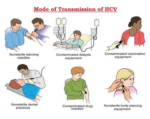 هپاتیت سی و راه های انتقال ویروس