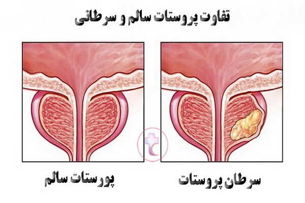 تفاوت پروستات سرطانی با پروستات سالم