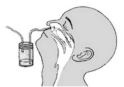 نمونه برداری عفونت تنفسی توسط آسپیرات نازوفارنکس