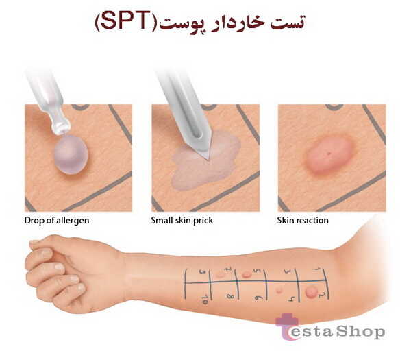 روش تست خاردار پوست (SPT)