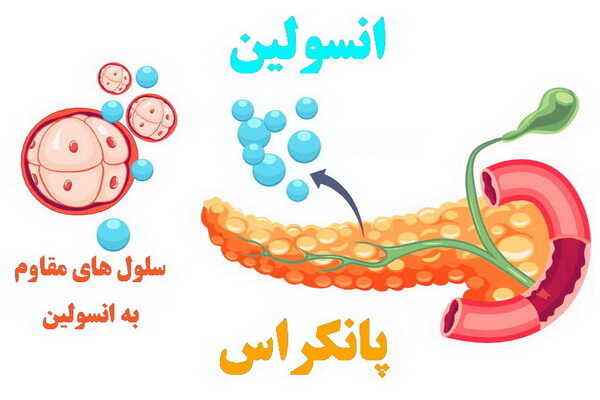 شماتیک پانکراس و انسولین- انسولین و بیماری دیابت