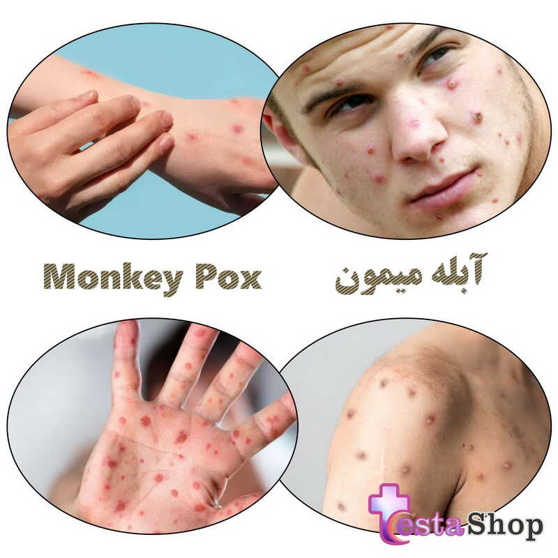 بیماری آبله میمون - تشخیص آبله میمون